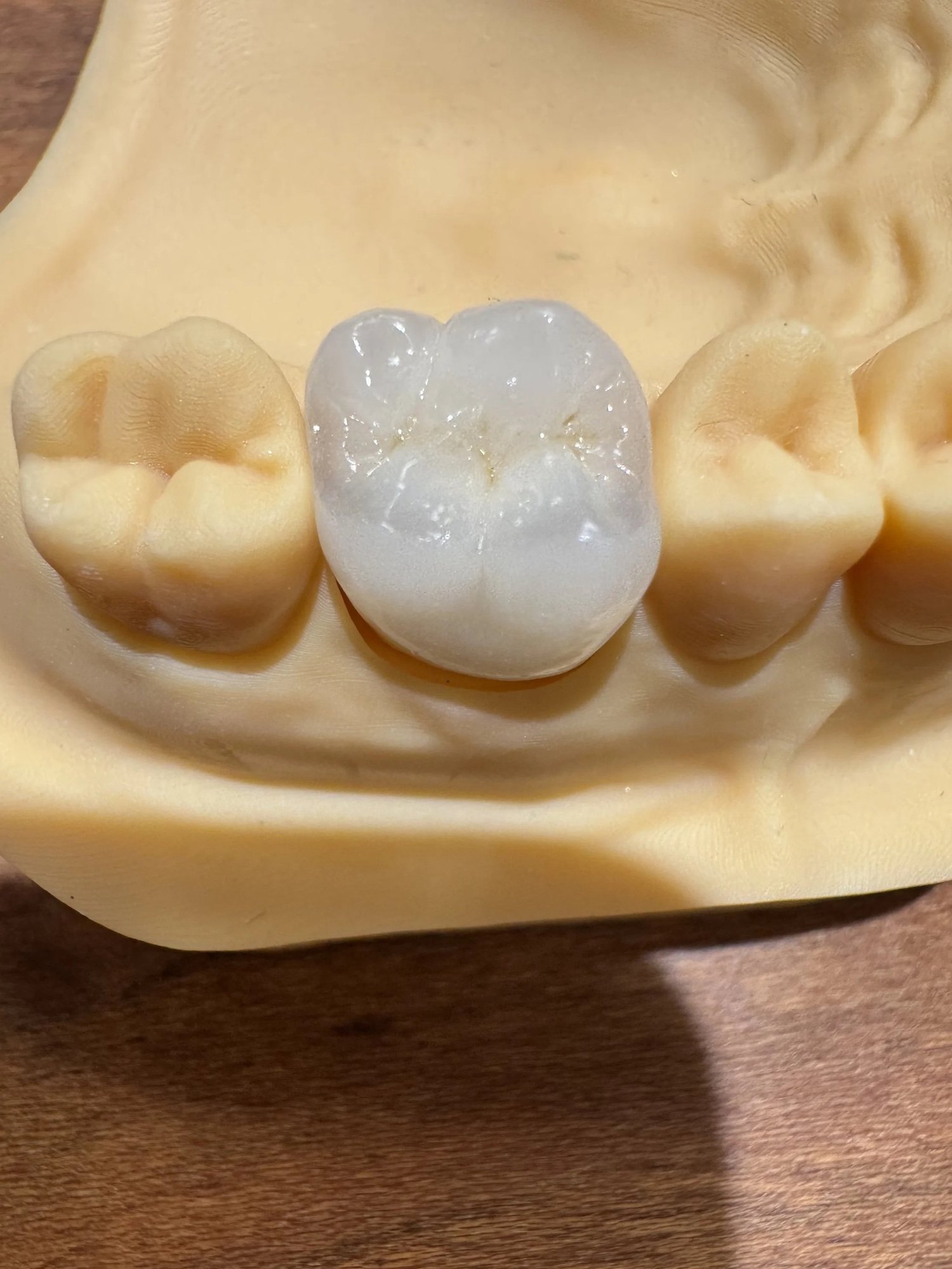 A finished zirconia crown seated between adjacent teeth on a dental model