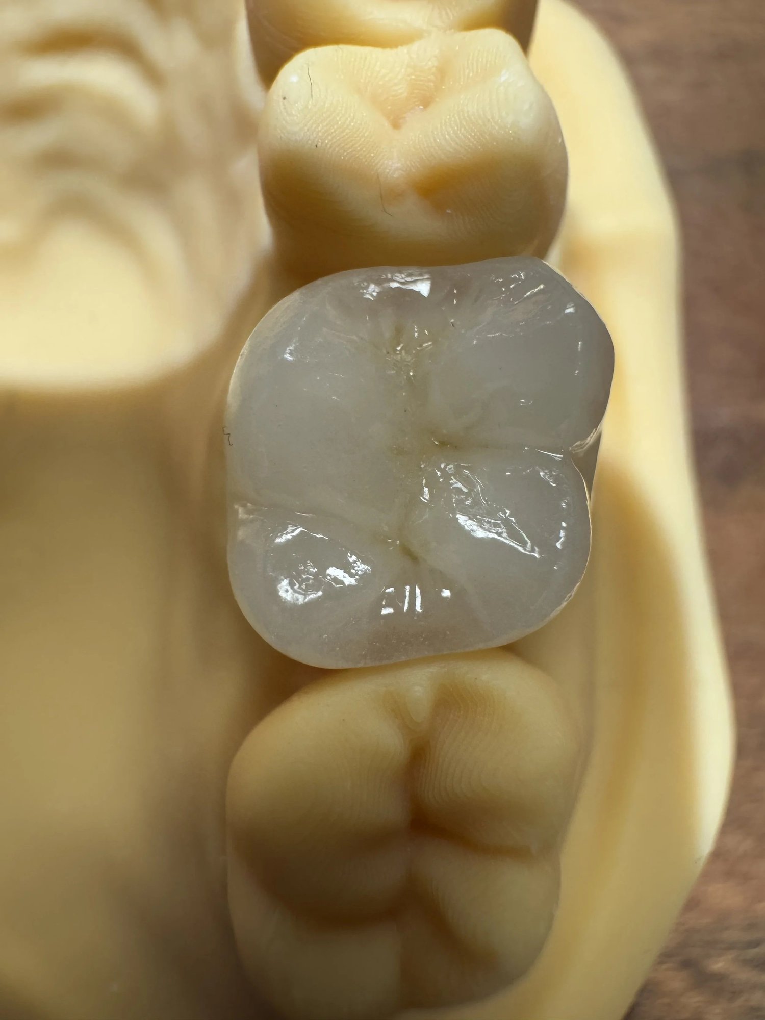 A layered zirconia crown seated on a stone dental model
